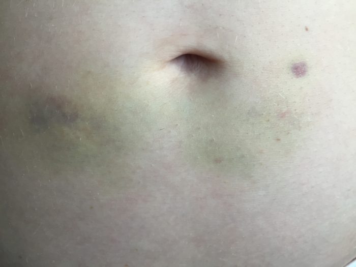 Infertility and IVF Q&A Part 1 featured by top infertility blog, A Slice of Style: image of a patient and injection bruises